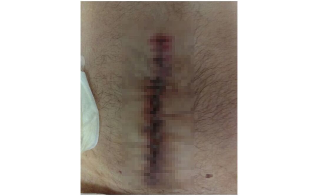 La herida del señor Juan Enríquez  (Foto: Especial) 