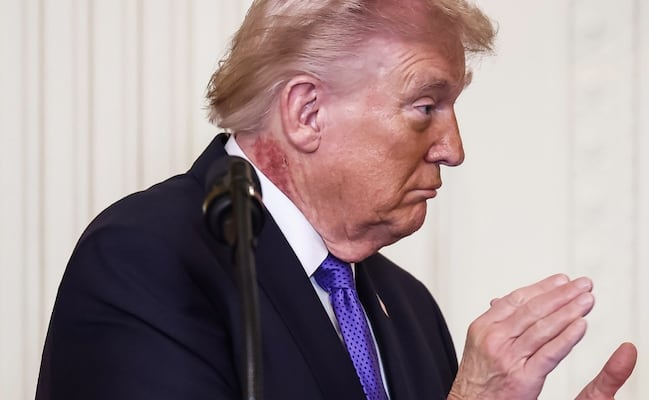 Captan erupción en el cuello de Donald Trump; médico asegura que responde a tratamiento preventivo