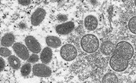 Registran casos de viruela de mono en dos niños en EU 