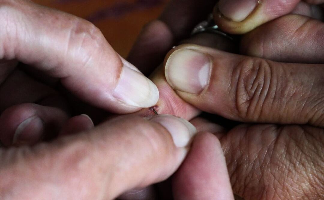 Heridas. Fuente: Pixabay