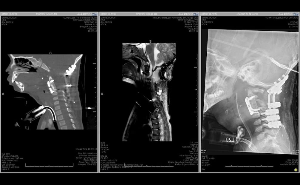 Radiografías tomadas después de la intervención en Chicago. En color blanco intenso resaltan a simple vista las piezas con que los médicos reensamblaron la anatomía de Oliver. Foto: Cortesía Dr. Mohamad Bydon.