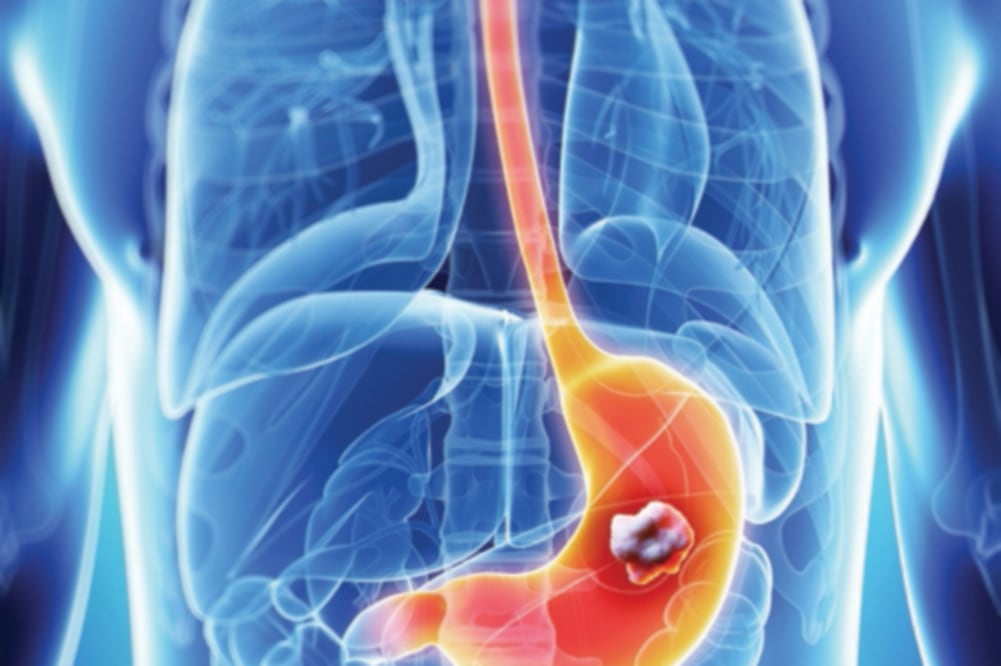 A nivel mundial, el cáncer gástrico ocupa el cuarto sitio en incidencia y el segundo en mortalidad; en nuestro país es la cuarta causa de muerte por cáncer entre hombres y la quinta entre mujeres. FOTO: Cortesía Doctor Castell Rodríguez.