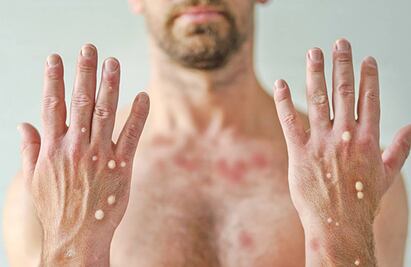 Chiapas reporta 2 casos más de viruela del mono