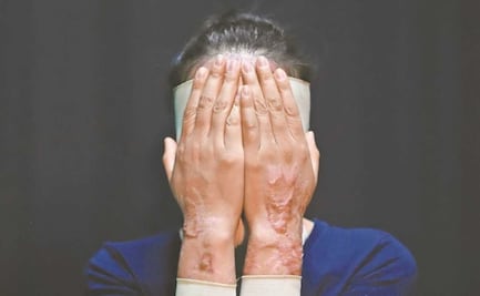 Van por 15 años de cárcel a quien infrinja lesiones por ácido