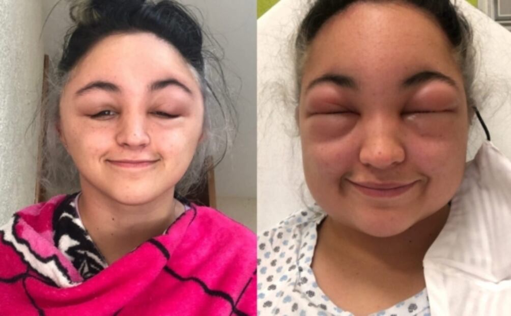 Mujer se pinta el pelo y le causa alergia: mira lo que pasó