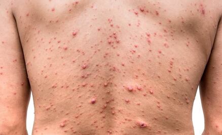 Pese a recomendaciones, tiendas comerciales en Sinaloa no toman medidas en vestidores para evitar contagios de la viruela del mono