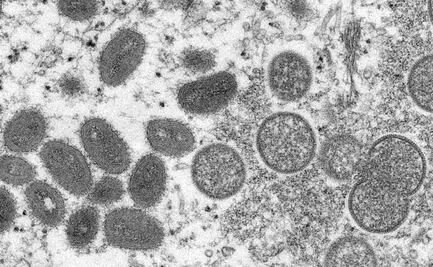 Detectan primer caso de viruela del mono en Suecia