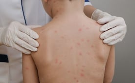 Suman 13 mil 855 casos de sarampión en México; Salud reporta 35 muertes en el país por el virus