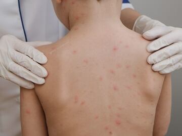 Confirman 13 nuevos casos de sarampión en Durango