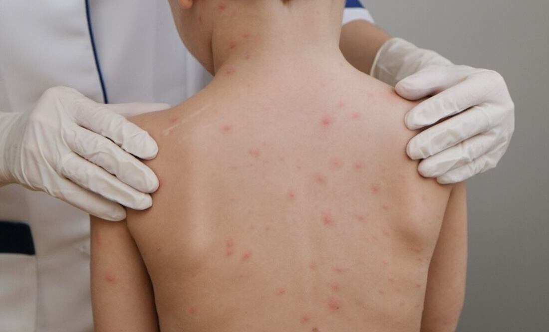 David Kershenobich recordó que el brote de sarampión llegó de importación de Texas. Foto: Especial