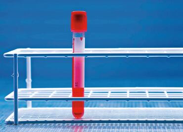 Científicos descubren un nuevo subtipo de cáncer en la sangre