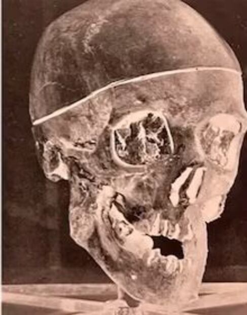 El caso Ruxton, un crimen que transformó la ciencia forense. Fuente: Freepik.