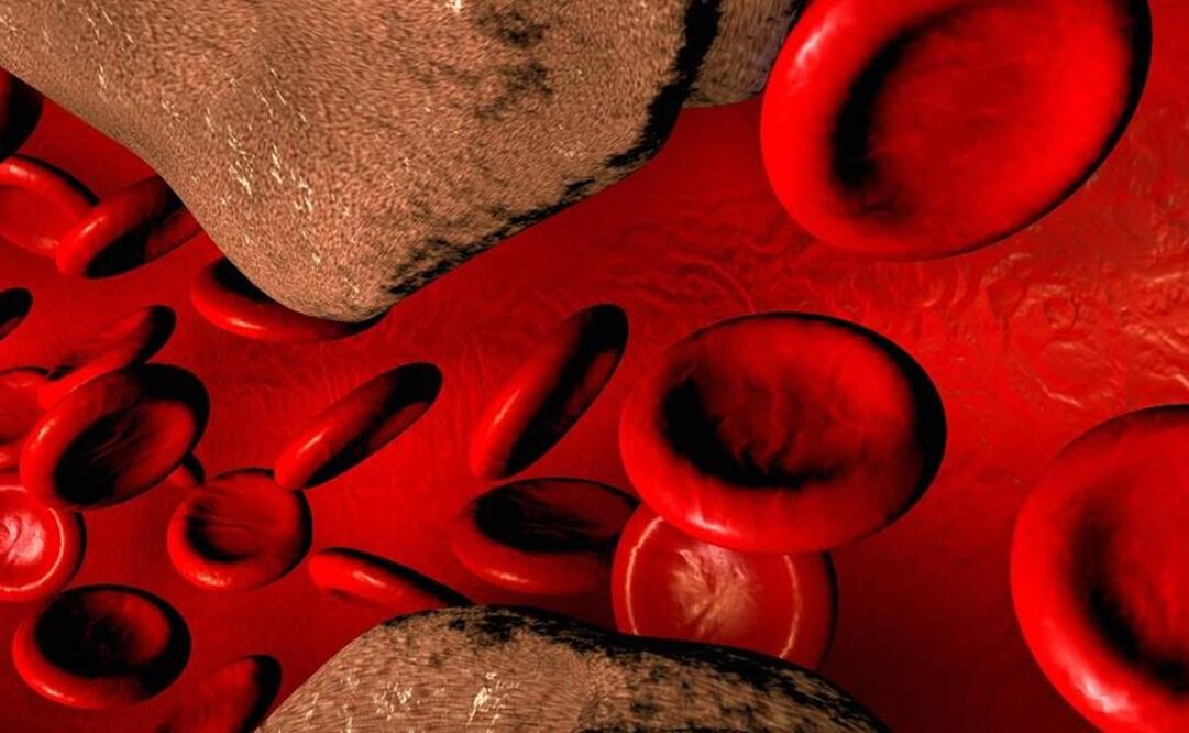 Determinados tipos de lipoproteínas, cuando se elevan demasiado, corren serios riesgos de incrustarse en las paredes de nuestras arterias produciendo las temidas placas de ateroma. Foto: GETTY IMAGES