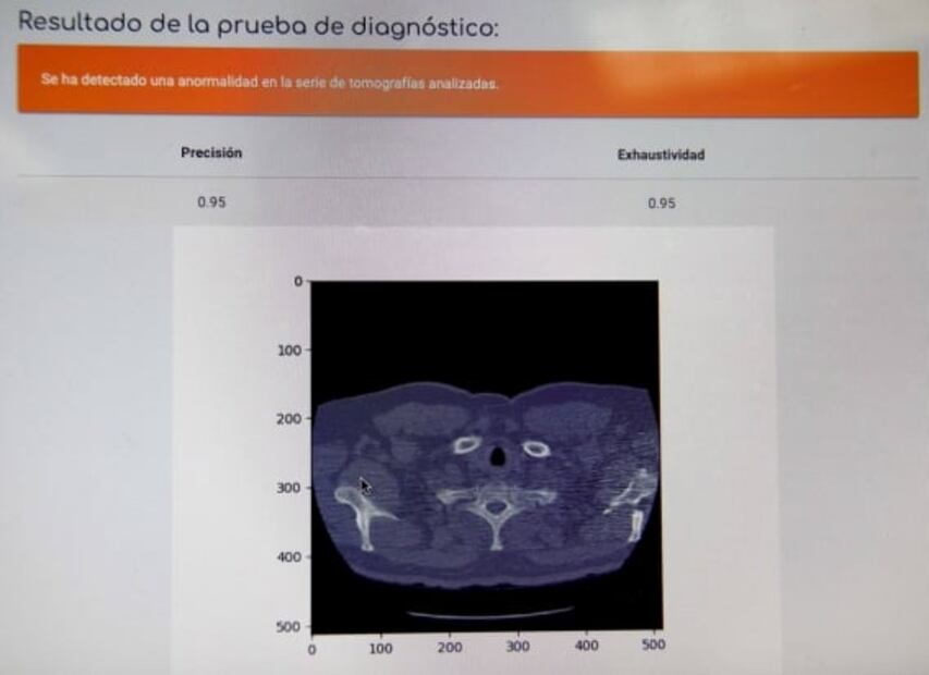 Politécnicos crean algoritmo para prediagnosticar cáncer de pulmón