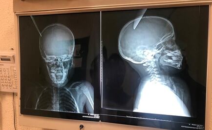 “Jugando”, niño lanza cuchillo a cabeza de menor en Sonora