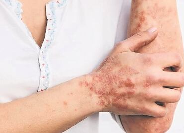 Brote de viruela del mono está bajo control en México, asegura especialista de la UNAM