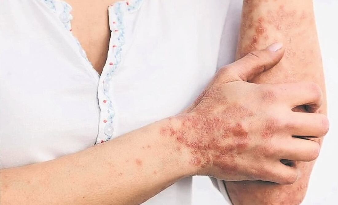 La OMS anunció a finales de noviembre que cambiaba el nombre de viruela del mono, monkeypox en inglés, a mpox. Foto: Archivo/EL UNIVERSAL