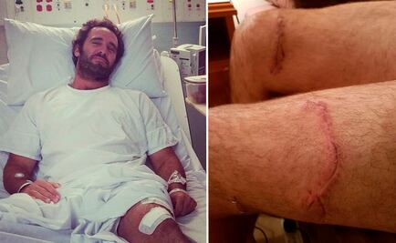 "Intenté meterle la tabla en la boca", surfista relata su batalla con un tiburón