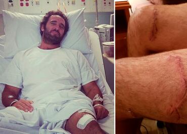 "Intenté meterle la tabla en la boca", surfista relata su batalla con un tiburón