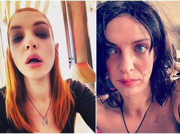 Hijo de Camilo Sesto alerta por extraños piquetes en el brazo: dice que se viste de mujer "para encontrarse"