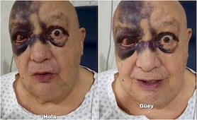 Luis de Alba sufre accidente y aparece con el rostro lleno de hematomas