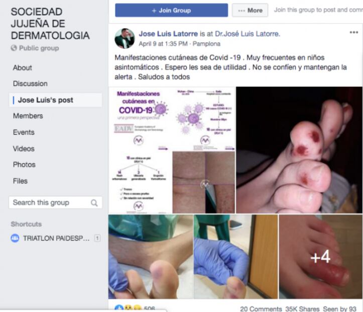 Sin comprobar, inflamaciones en el cuerpo por Covid-19