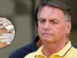 Jair Bolsonaro: ¿qué es el cáncer de piel, enfermedad que padece el expresidente de Brasil?
