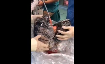 Negros e inservibles: así recibió pulmones para donación un médico en China 