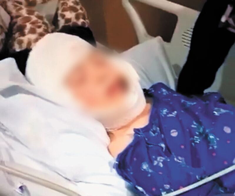 El niño de ocho años no volverá a tener el mismo rostro, pero se prevé que sanará y podrá llevar una vida normal. Foto/ESPECIAL