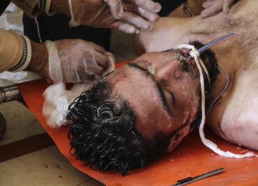 Entérate. ¿Qué sienten las víctimas de un ataque químico?