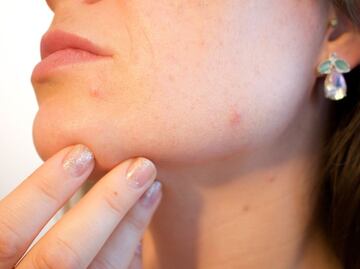 Descubre qué es el acné quístico