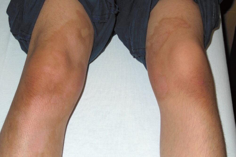 El tratamiento aplicado fue a base de piel cultivada a través de unas gasas de nombre epifast que le fueron colocadas en diferentes partes del cuerpo (IMSS)