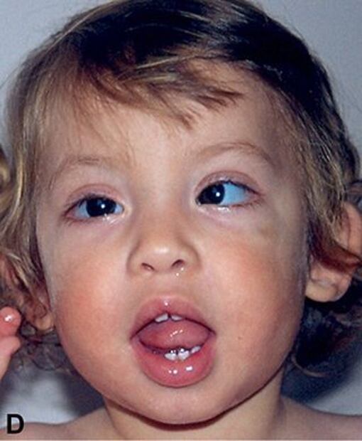 El síndrome de Kabuki es una patología poco común. Foto: Especial