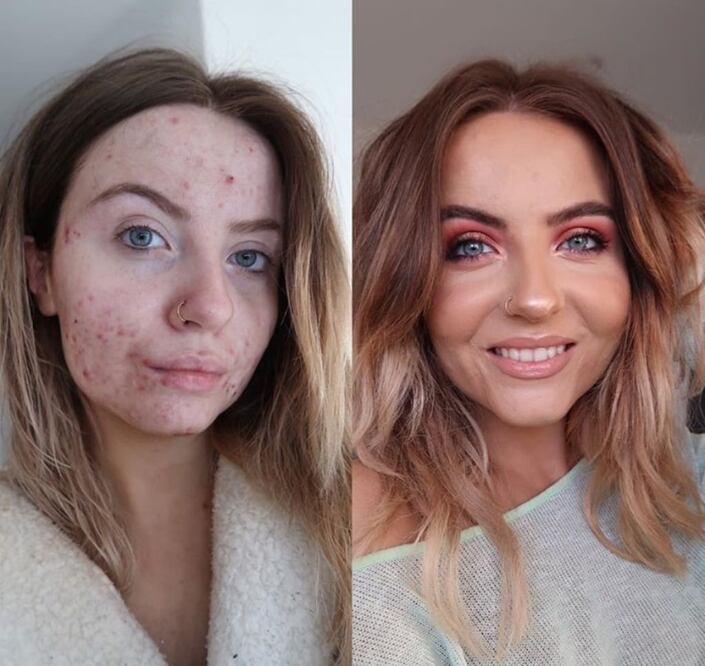 Abbie Bull muestra un antes y después de usar la base de maquillaje que logra cubrir el 100% de sus imperfecciones. 