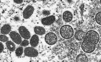 Viruela del mono se extiende a Suecia e Italia