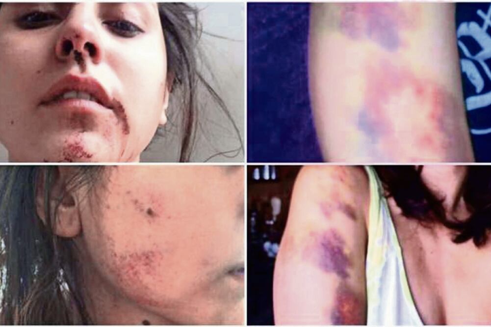 Tras el incidente Gamma presentó fractura de nariz (FACEBOOK)