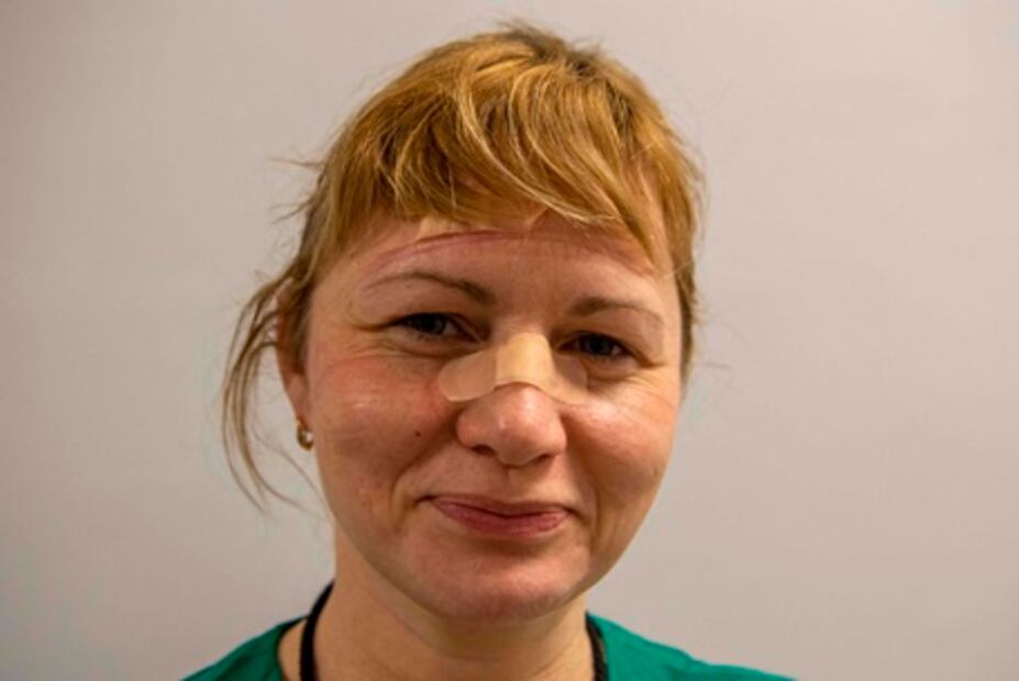 Así queda la cara al usar una mascarilla N95 13 horas seguidas