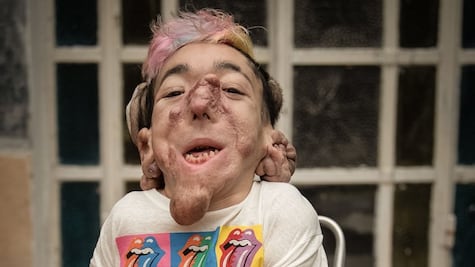 Matías Fernández Burzaco, el periodista y músico que vive con fibromatosis hialina juvenil