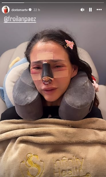 Dorismar se recupera de una reconstrucción nasal.