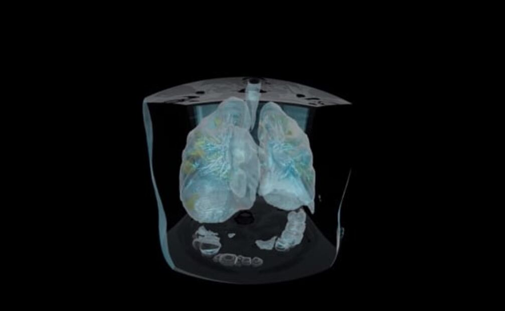 Así se ve el daño del Covid-19 en los pulmones