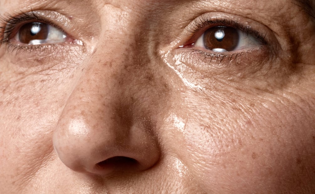 Dormir mal provoca la aparición de ojeras. Foto: Freepik