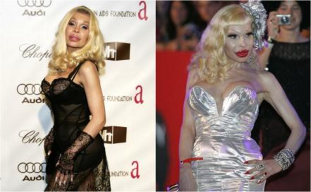 Personalidades de la moda que se pasaron de cirugías