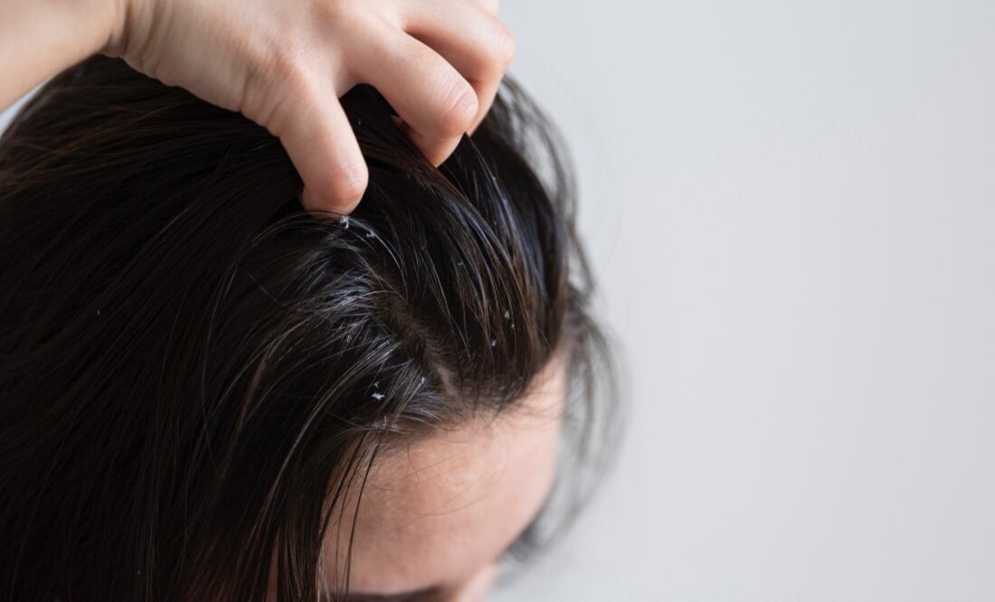 Errores cotidianos pueden empeorar la caspa. Foto: Freepik