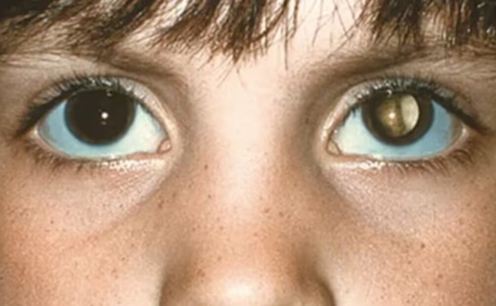 El retinoblastoma es un cáncer ocular que comienza en la retina, la capa de células nerviosas que recubre la parte posterior del ojo. Foto: American Academy of Ophthalmology