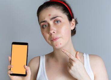 Así puedes evitar que el uso del móvil te saque acné