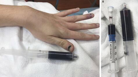 El extraño caso de una mujer a la que la sangre se le volvió azul en EU