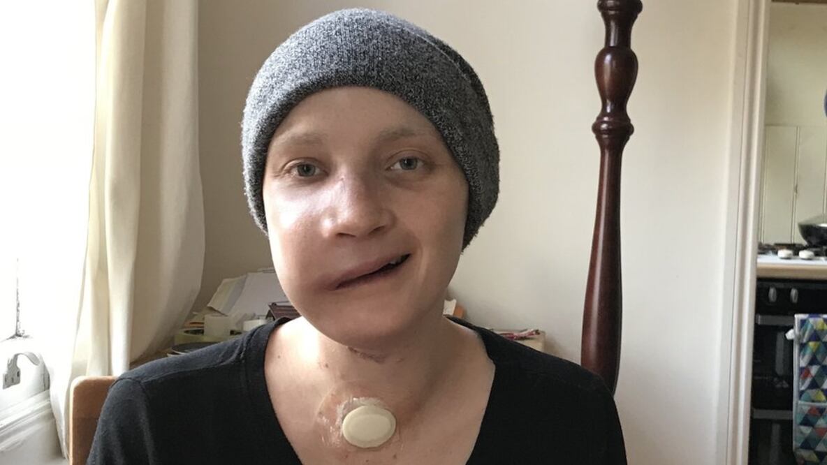 Jen Taylor Tras varias cirugías de reconstrucción facial Jen tuvo que volver a aprender a masticar.