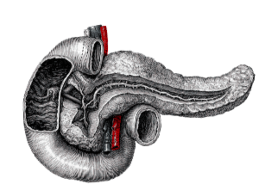 ¿Qué es la Pancreatitis Aguda?