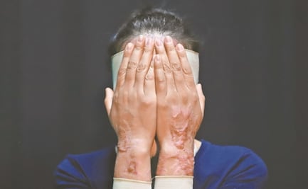 Denuncian ataque con ácido a una mujer en Puebla