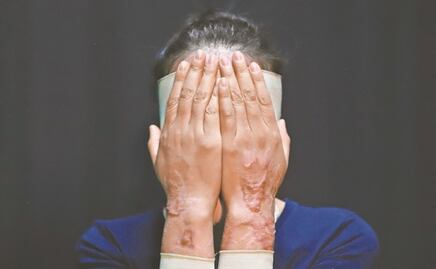 Denuncian ataque con ácido a una mujer en Puebla